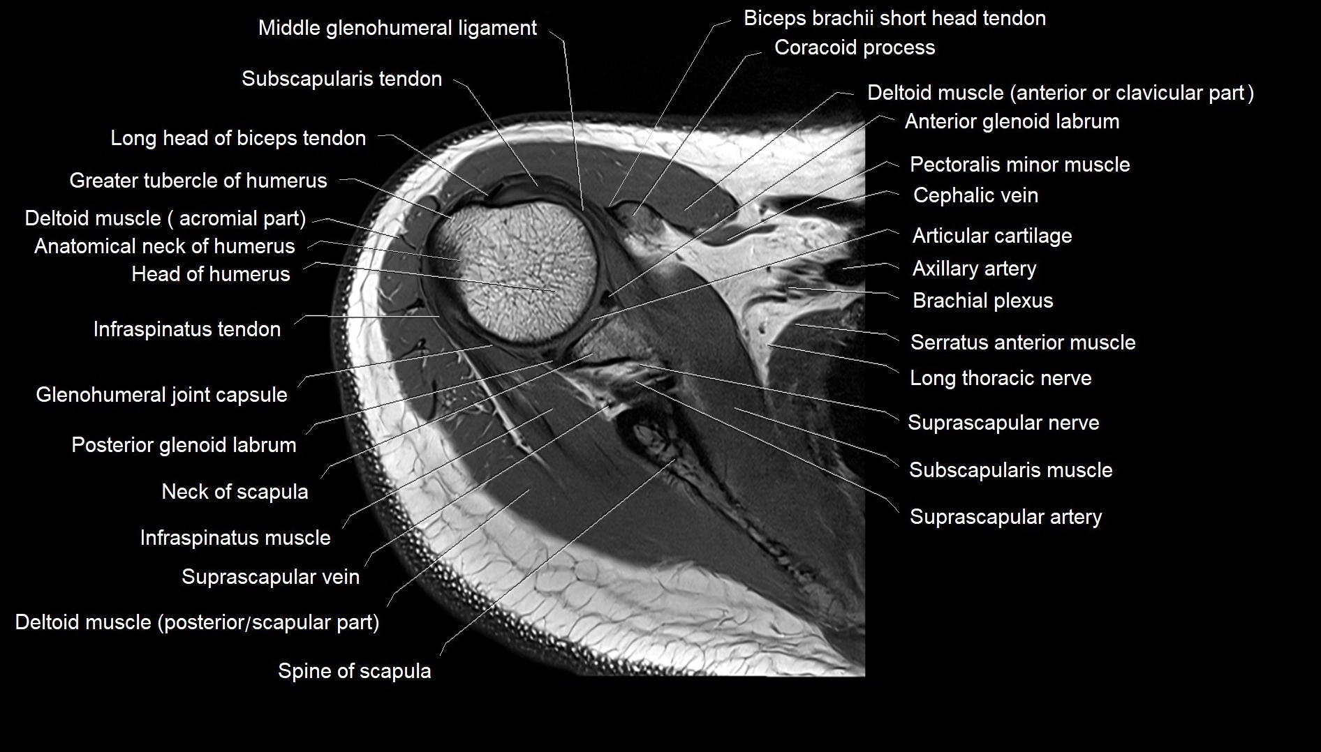 Shoulder cross sectional anatomy MRI 3T axial image 15.webp